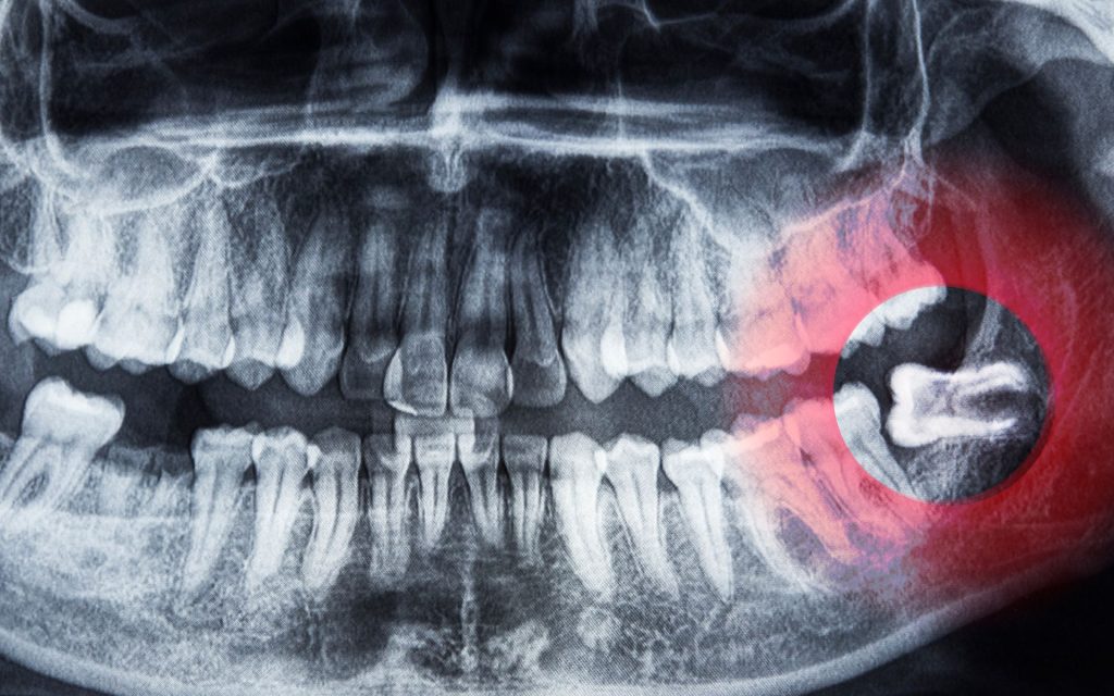 wisdom teeth removal x ray