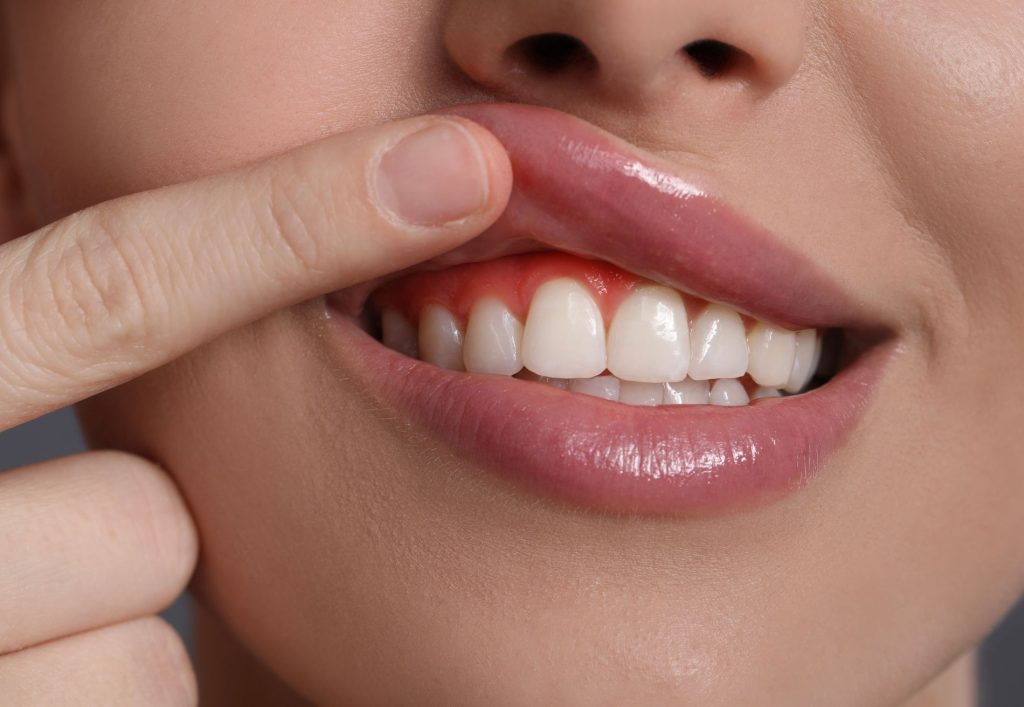 gum disease information
