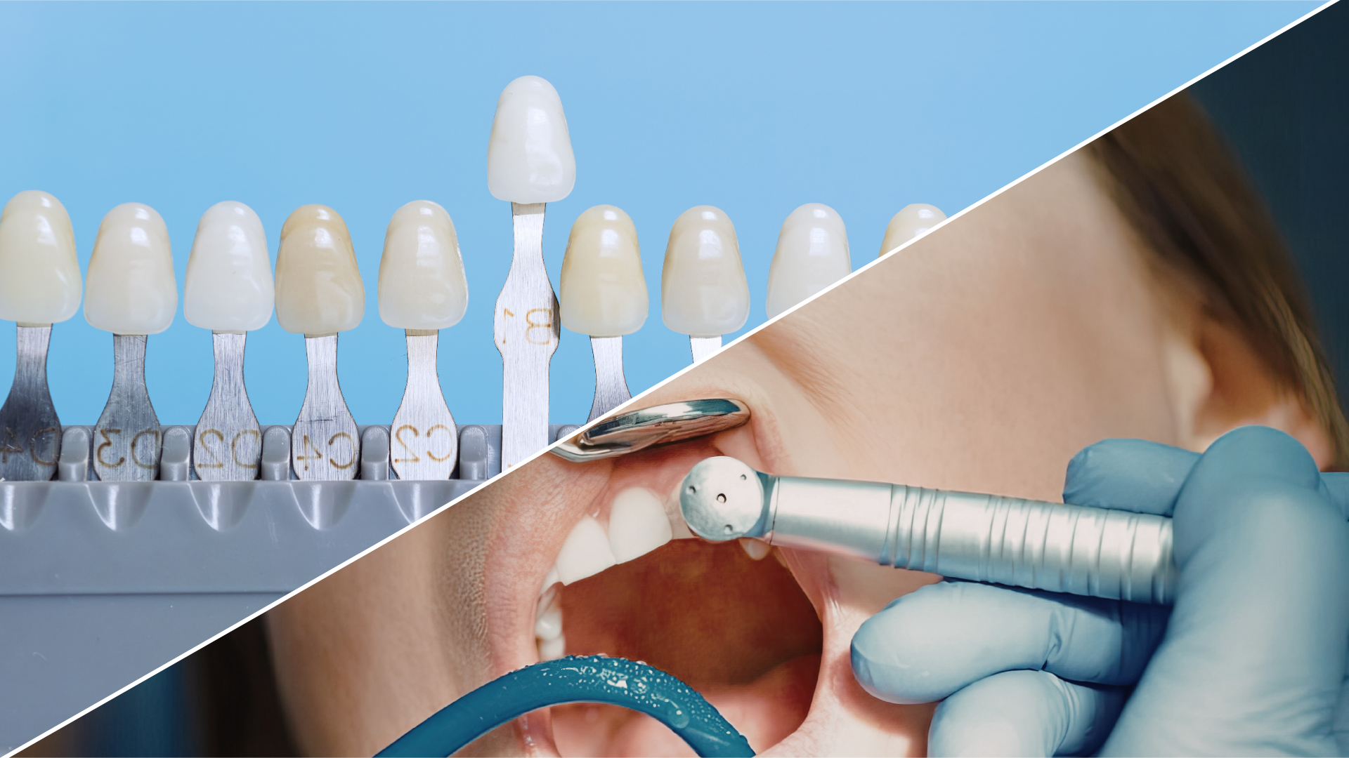 Dental bonding vs veneers - Eastside Family Dentistry Dental bonding vs veneers
