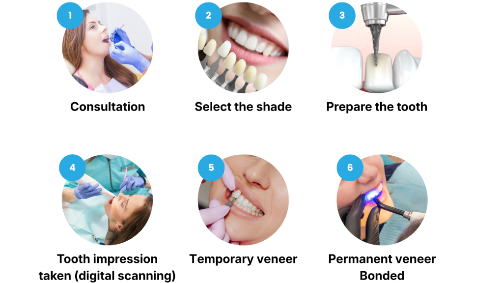 Veneer Process Diagram 2 - Eastside Family Dentistry Veneer Process Diagram